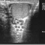 varicocele-scan_thumb.jpg